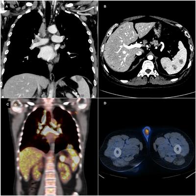 Case Report: Testicular Sarcoidosis: The Diagnostic Role of Contrast-Enhanced Ultrasound and Review of the Literature